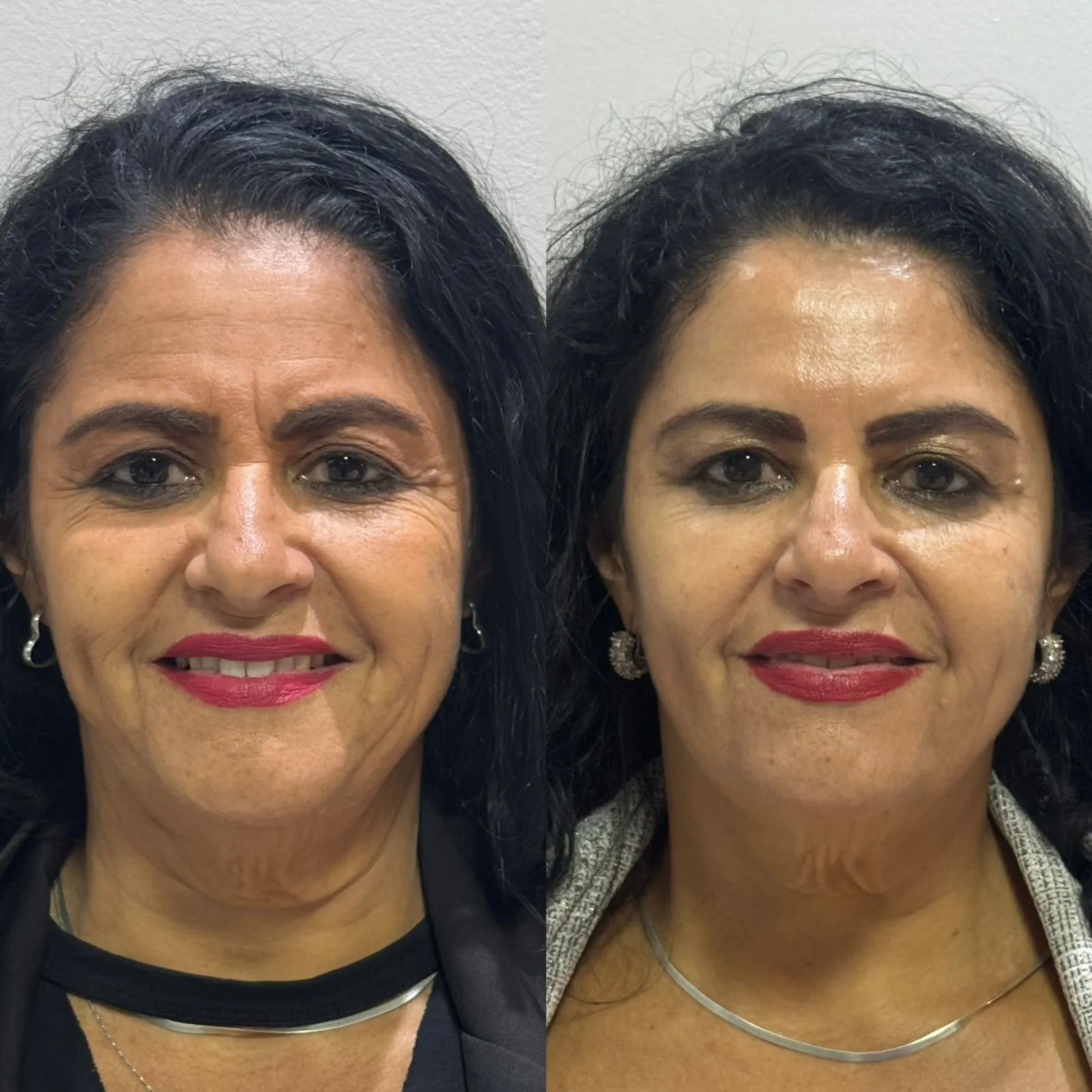 Botox depois — resultado de tratamento estético no Instituto Dra Danuza