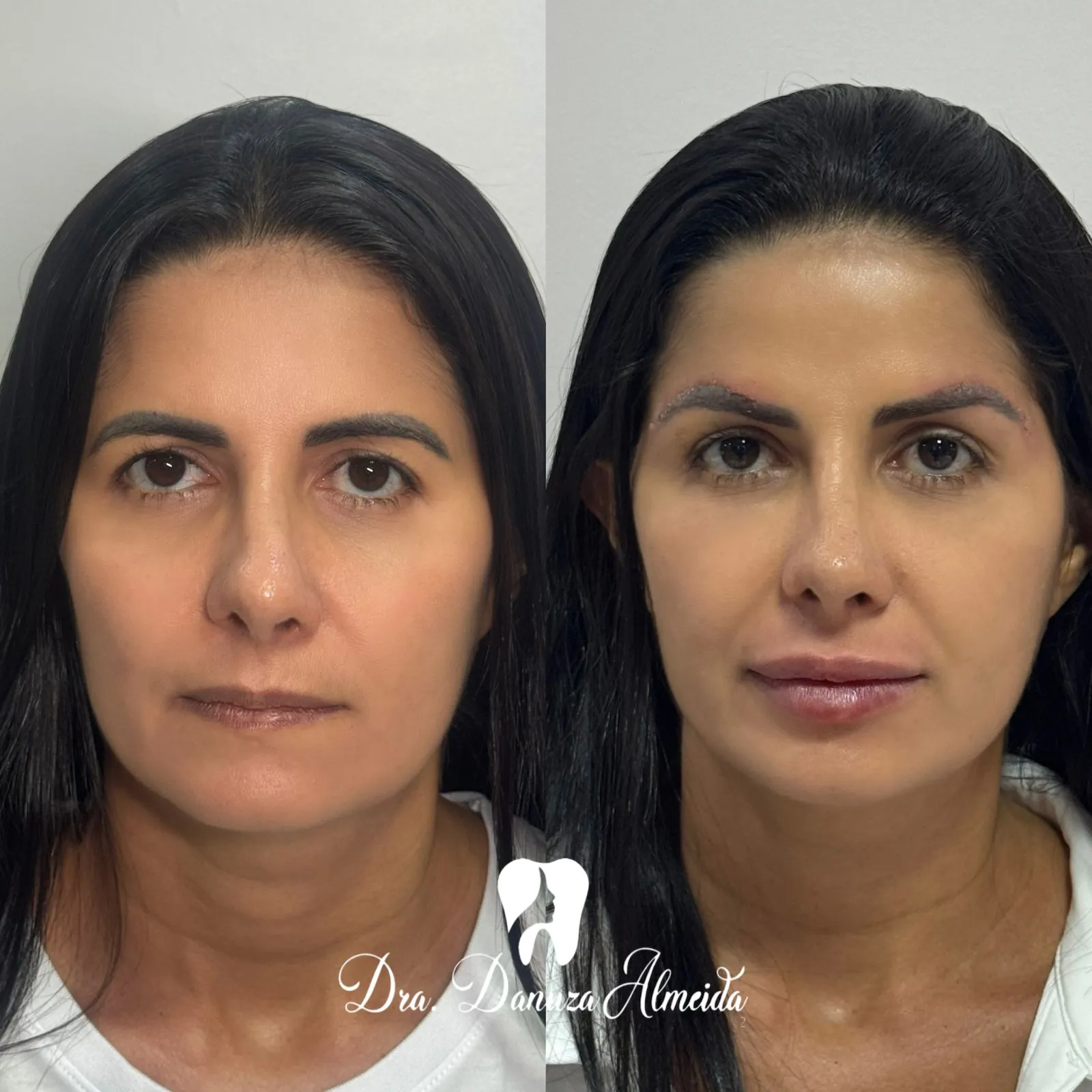 Cirurgia de Castanhares depois — resultado de tratamento estético no Instituto Dra Danuza