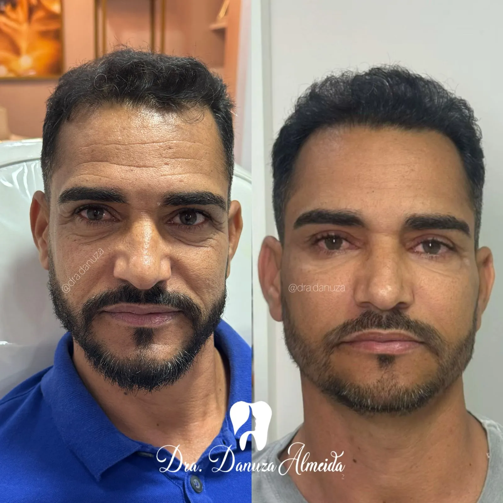 Harmonização Masculina antes — Instituto Dra Danuza Almeida, Petrolina-PE