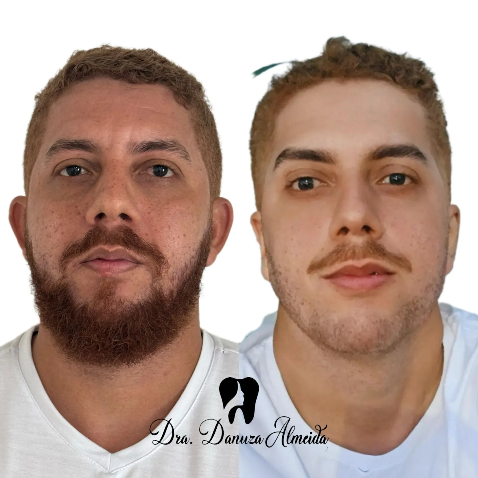 Harmonização Masculina depois — resultado de tratamento estético no Instituto Dra Danuza