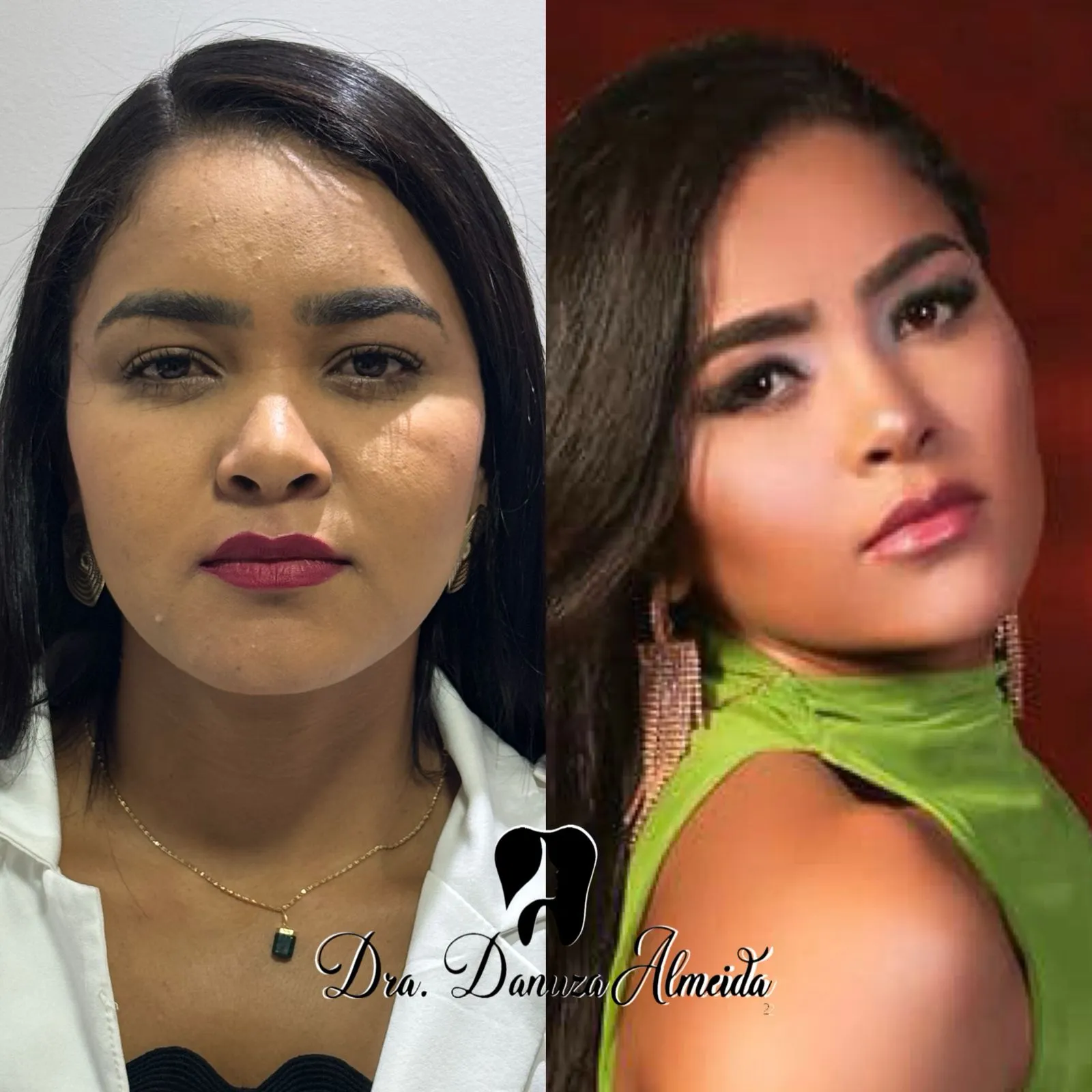 Bichectomia - Imagem 1