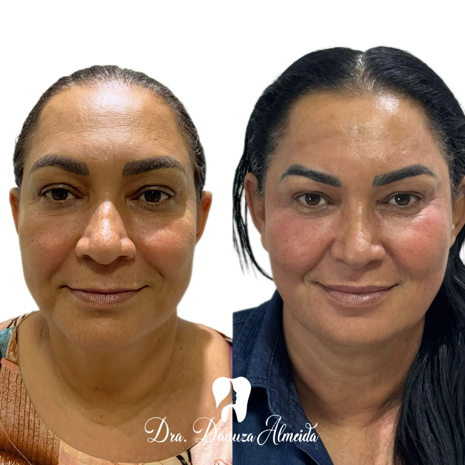 Fios de Colágeno - Imagem 1