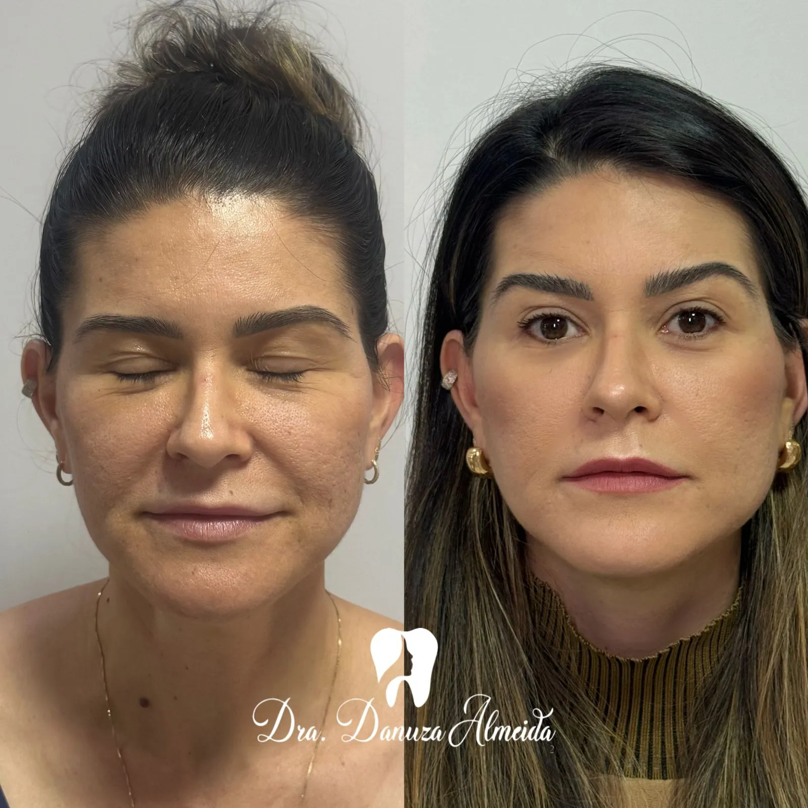 Fios de Colágeno - Imagem 2