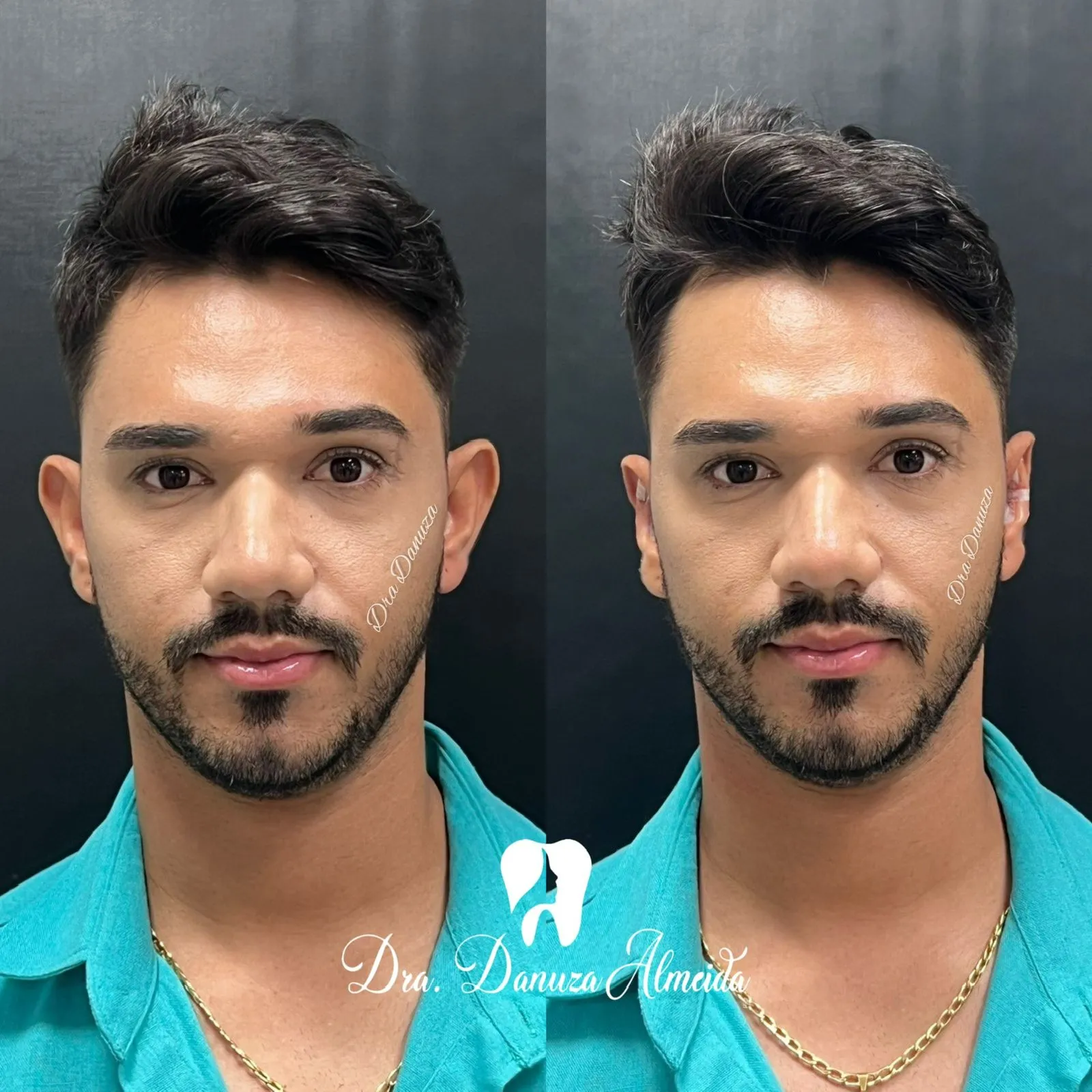 Otomodelação - Imagem 2