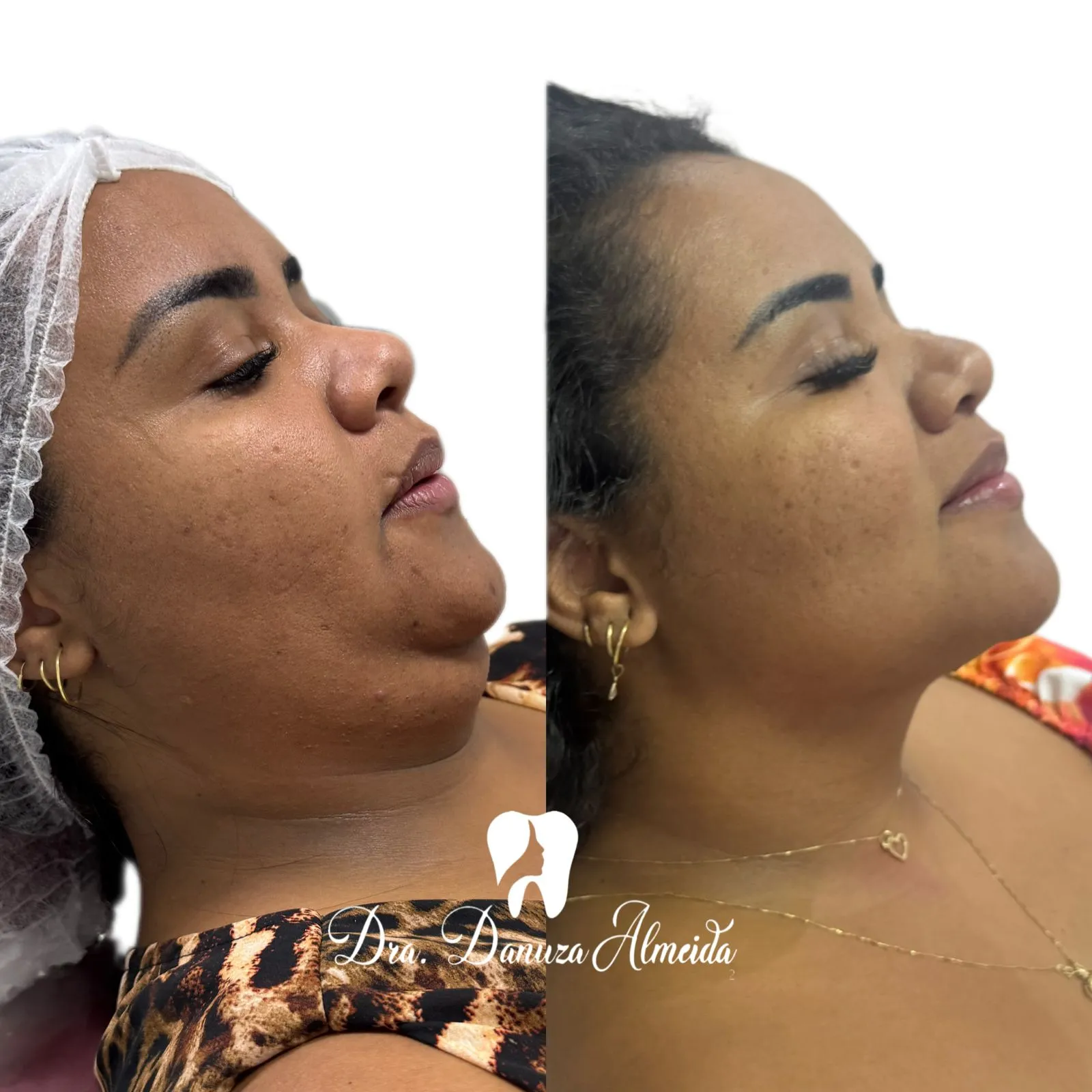 Lipo de Papada - Imagem 1