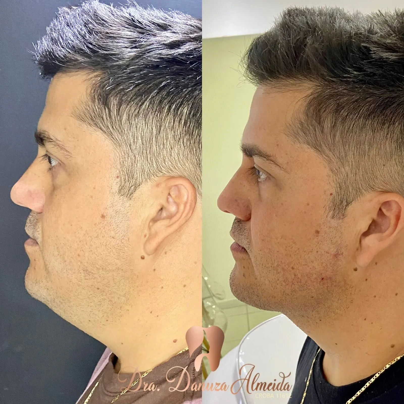 Lipo de Papada - Imagem 2