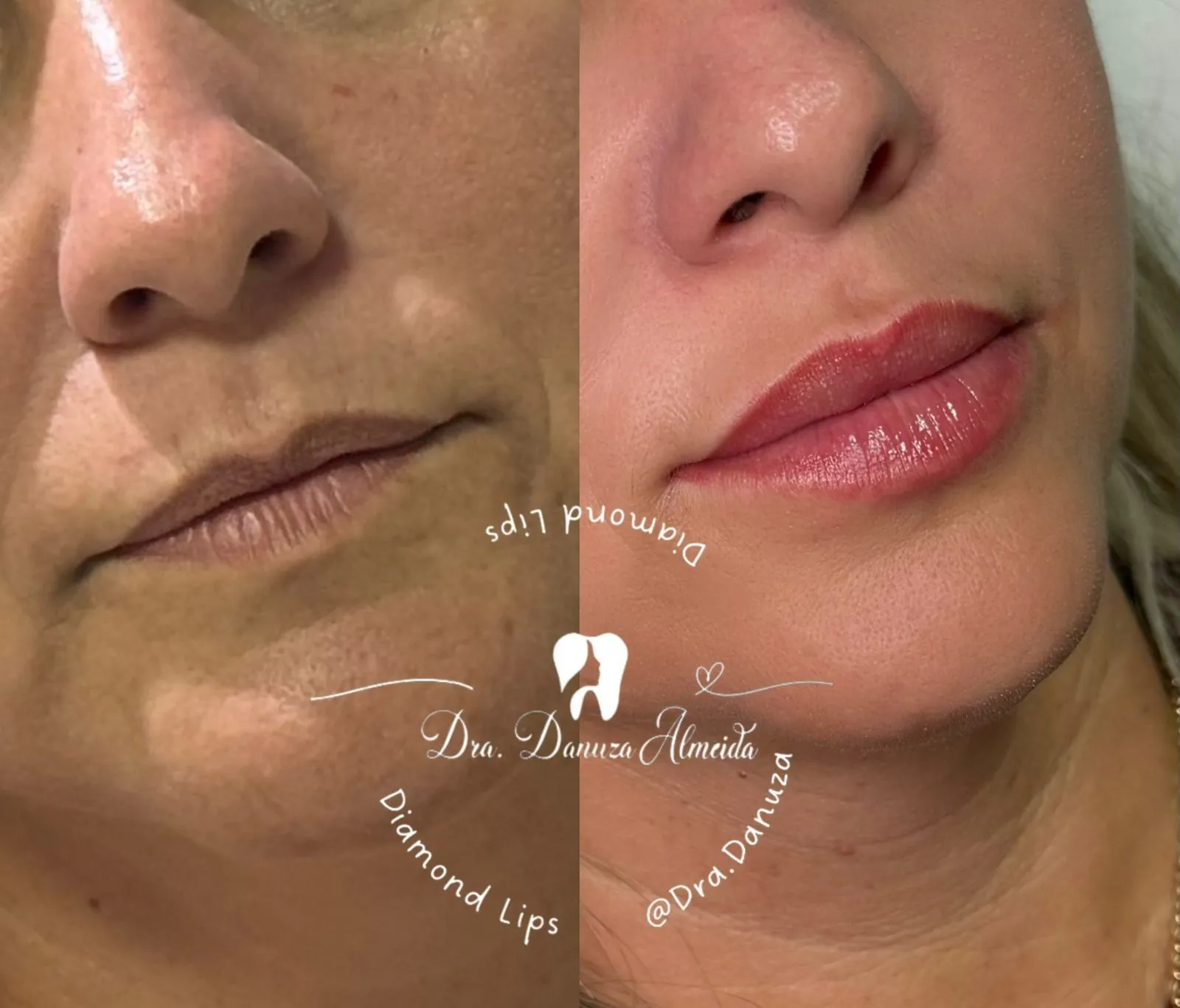 Preenchimento Labial - Imagem 1