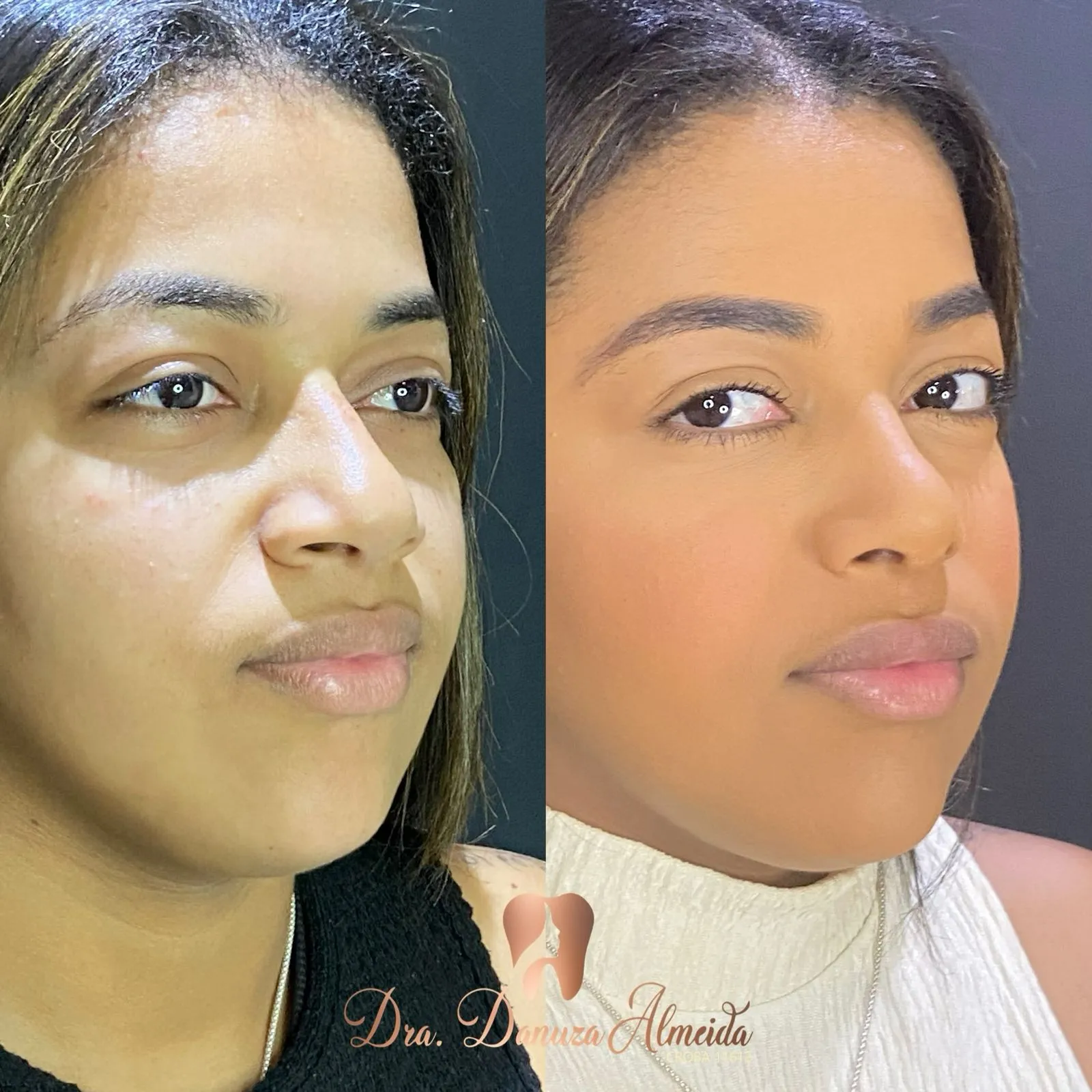 Rinomodelação - Imagem 1